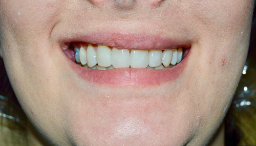 misshapen-teeth-after-image